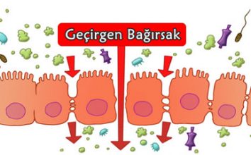 GEÇİRGEN BAĞIRSAK SENDROMU NEDİR? NEDENLERİ VE TEDAVİ YÖNTEMLERİ NELERDİR?
